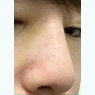 13日目の経過画像（2枚目）
