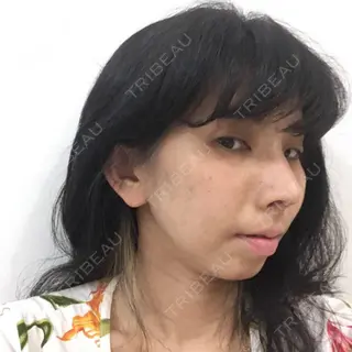 31日目の経過画像（2枚目）