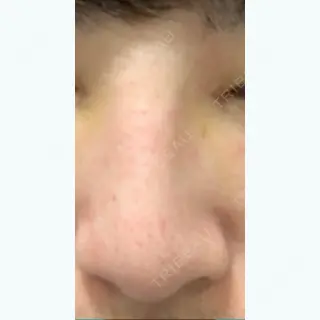 14日目の経過画像（1枚目）