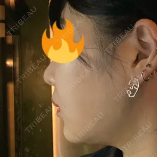 11日目の経過画像（3枚目）