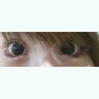 0日目の経過画像（1枚目）