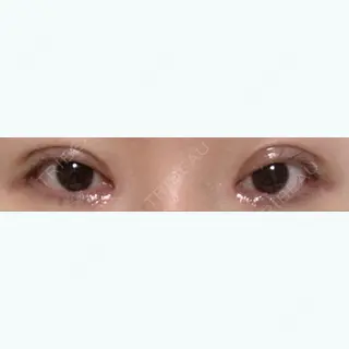 29日目の経過画像（1枚目）