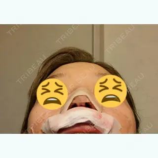 0日目の経過画像（3枚目）