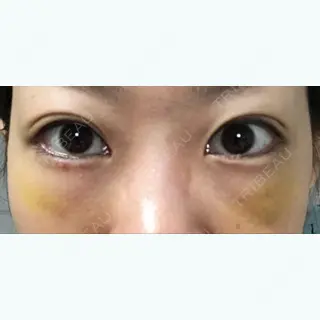 9日目の経過画像（1枚目）