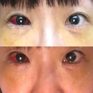 4日目の経過画像（1枚目）