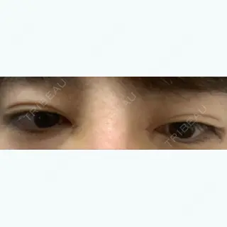 18日目の経過画像（1枚目）