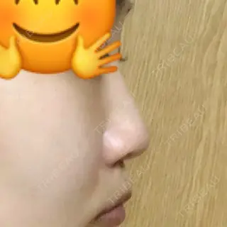 2日目の経過画像（1枚目）