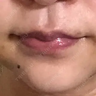6日目の経過画像（1枚目）