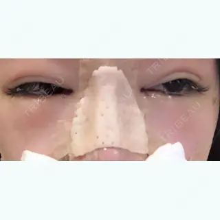 0日目の経過画像（2枚目）