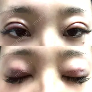 1日目の経過画像（1枚目）
