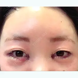 2日目の経過画像（1枚目）