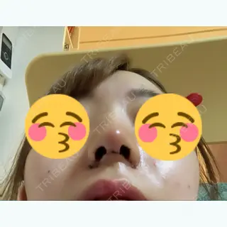 4日目の経過画像（3枚目）