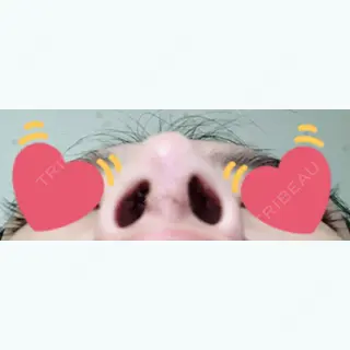 7日目の経過画像（3枚目）