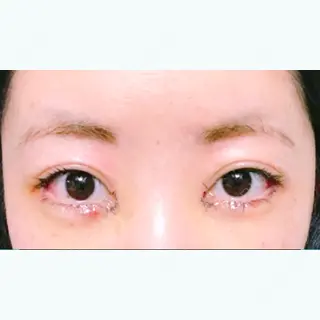 3日目の経過画像（1枚目）