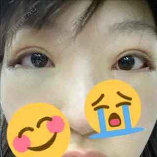 0日目の経過画像（1枚目）