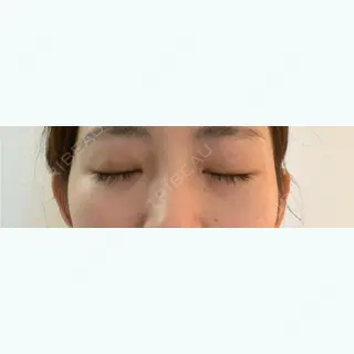 28日目の経過画像（2枚目）