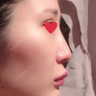6日目の経過画像（2枚目）