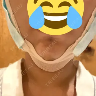 0日目の経過画像（3枚目）