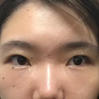 37日目の経過画像（1枚目）