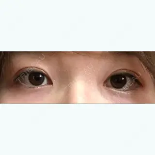 6日目の経過画像（1枚目）