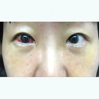 9日目の経過画像（1枚目）