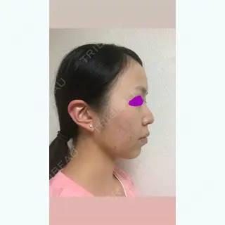 5日目の経過画像（3枚目）