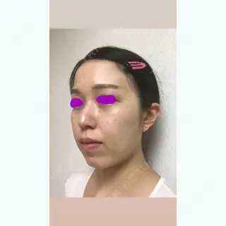 6日目の経過画像（2枚目）