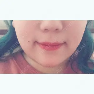 7日目の経過画像（2枚目）