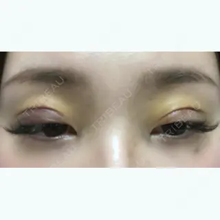 4日目の経過画像（2枚目）