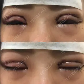 1日目の経過画像（1枚目）