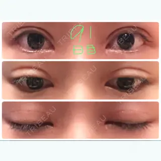 91日目の経過画像（1枚目）