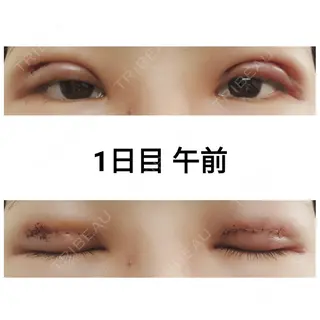 1日目の経過画像（1枚目）