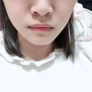 13日目の経過画像（1枚目）
