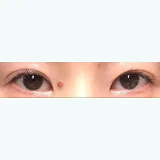 87日目の経過画像（1枚目）
