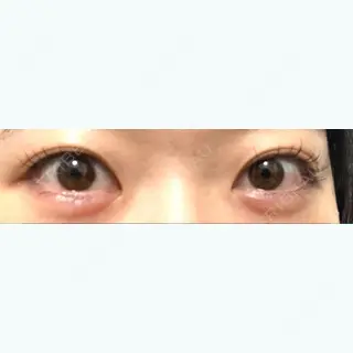 0日目の経過画像（1枚目）