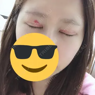 11日目の経過画像（2枚目）