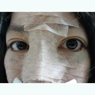 0日目の経過画像（1枚目）