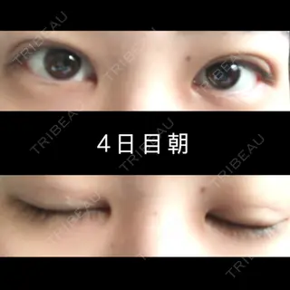 4日目の経過画像（1枚目）