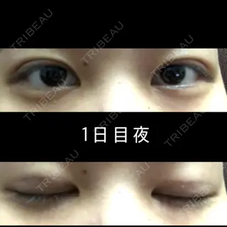 1日目の経過画像（1枚目）