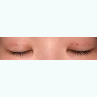 2日目の経過画像（2枚目）
