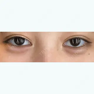 1日目の経過画像（1枚目）