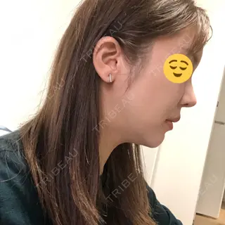 15日目の経過画像（1枚目）
