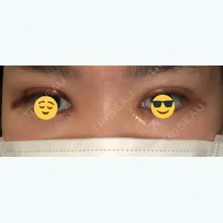 5日目の経過画像（1枚目）