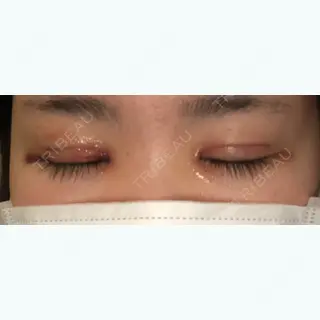 5日目の経過画像（2枚目）