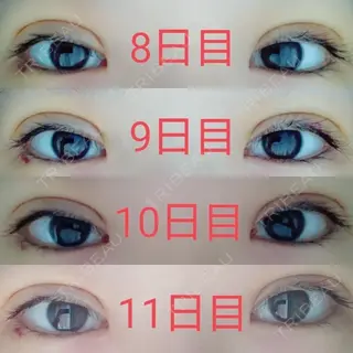 11日目の経過画像（2枚目）