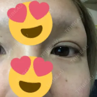 2日目の経過画像（2枚目）
