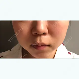 22日目の経過画像（1枚目）
