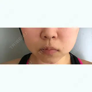 28日目の経過画像（1枚目）