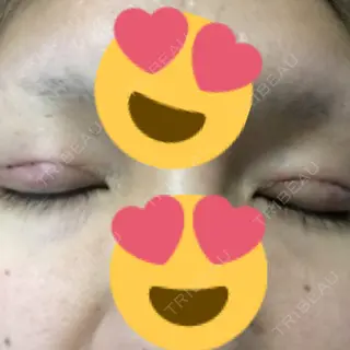 3日目の経過画像（2枚目）