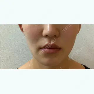 35日目の経過画像（1枚目）